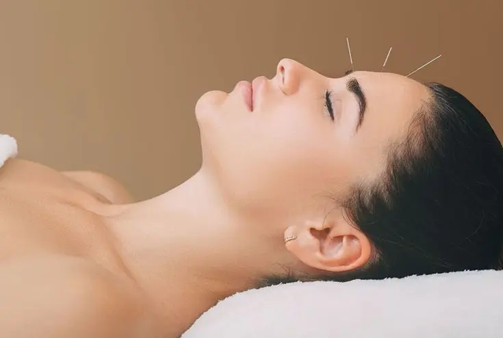 A patient resting comfortably during acupuncture