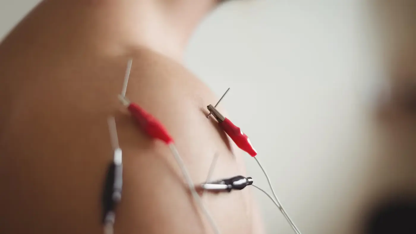 Electroacupuncture clips connected to fine acupuncture needles