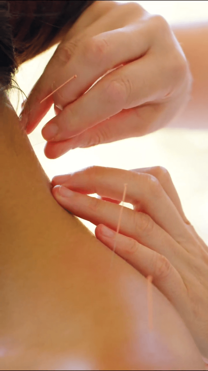 Fine acupuncture needles being placed during pain-focused care