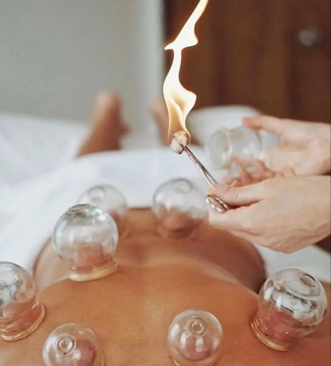 Traditional fire cupping preparation with a controlled flame