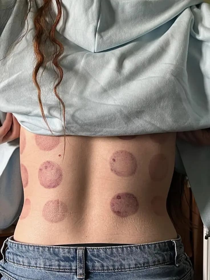 Temporary circular marks on the back after cupping
