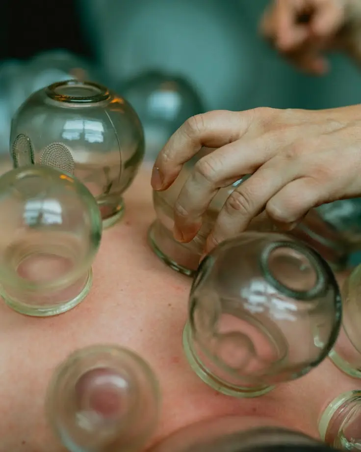 Glass cups being placed during a cupping treatment