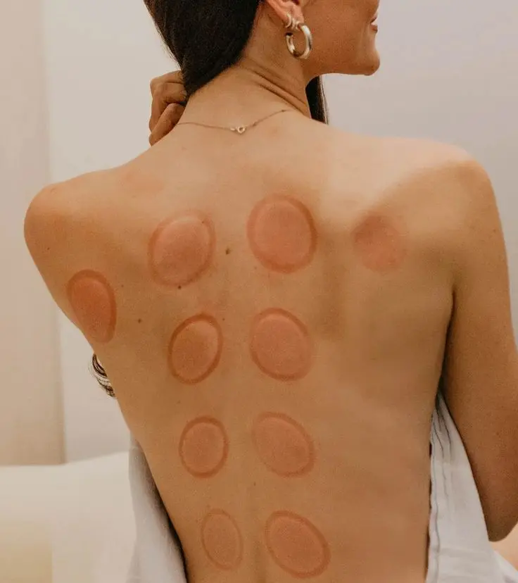 Temporary circular marks on the back following cupping